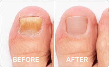 Before and after results