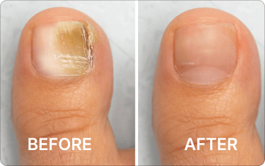 Before and after results